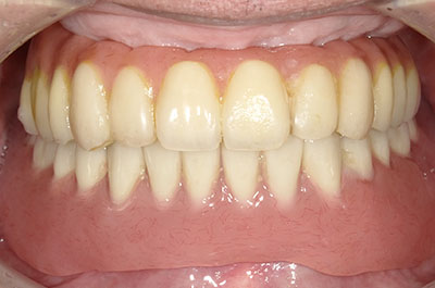 義歯症例