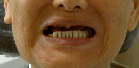 驚くばかり 30 代 歯 が ボロボロ 女 ラクスモン