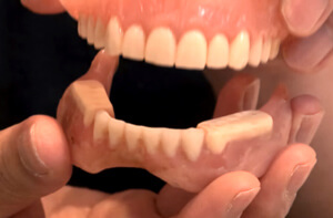 リハビリ用(治療用)入れ歯を使用