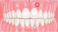 歯周病による変色