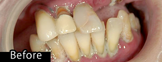 即時義歯before