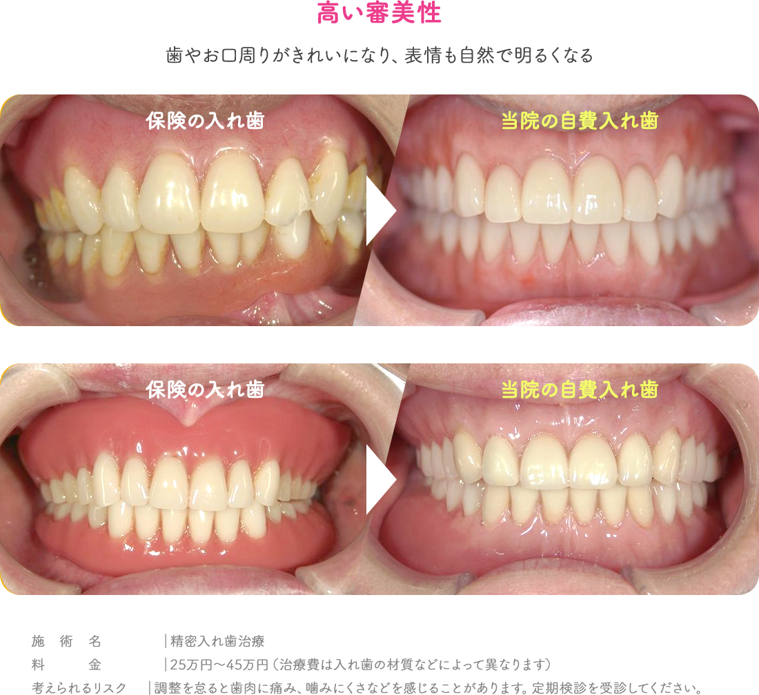 高い審美性 歯やお口周りがきれいになり、表情も自然で明るくなる