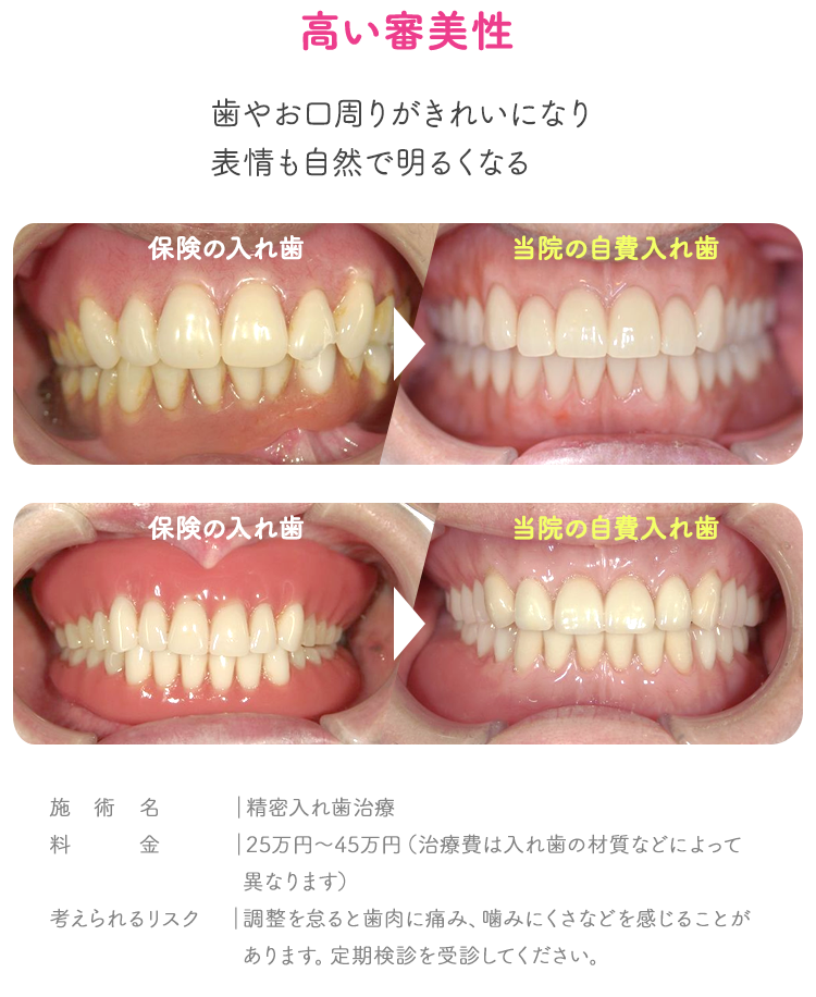 高い審美性 歯やお口周りがきれいになり、表情も自然で明るくなる