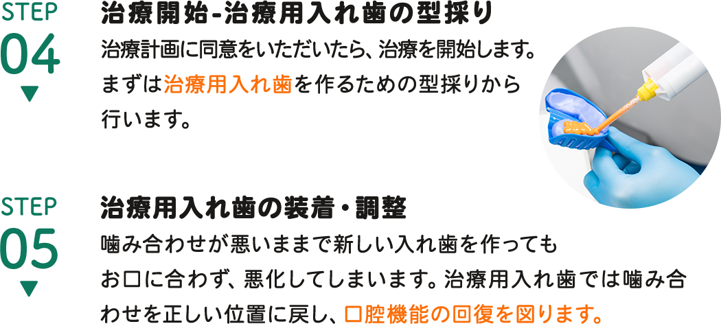 STEP4 治療開始-治療用入れ歯の型採り, STEP5 治療用入れ歯の装着・調整