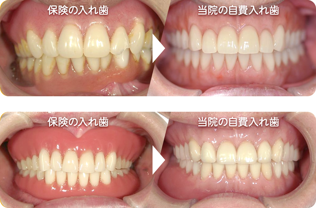 保険の入れ歯と当院の自費入れ歯の比較