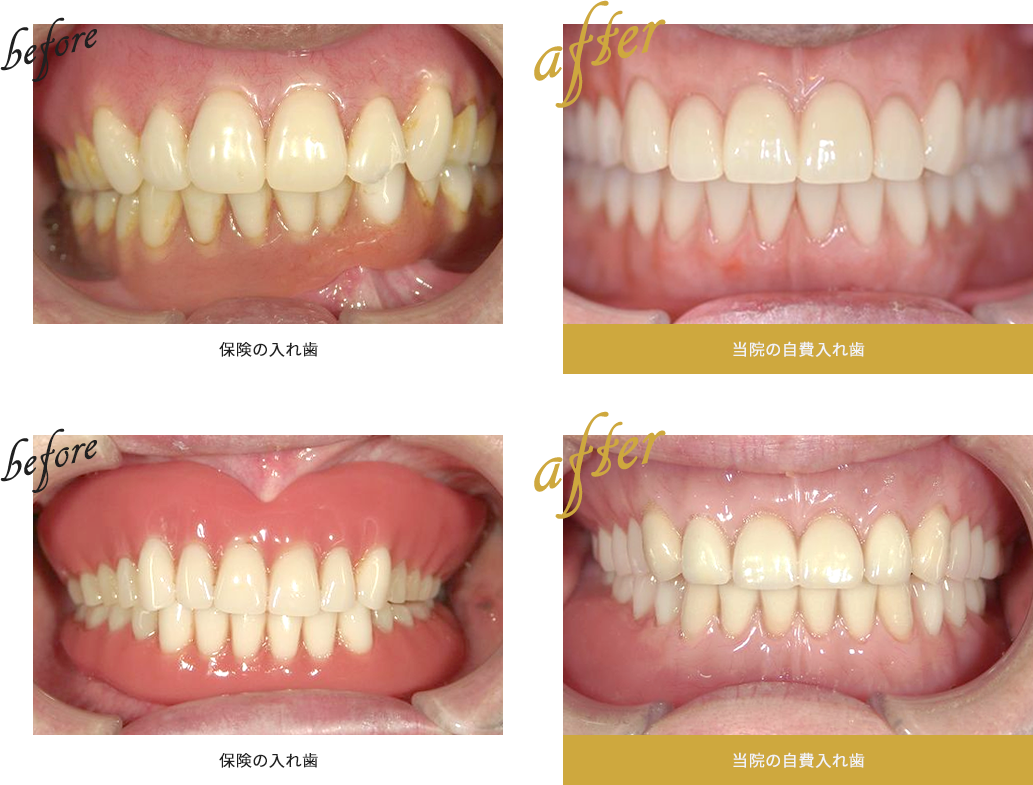 保険の入れ歯と当院の自費入れ歯の比較