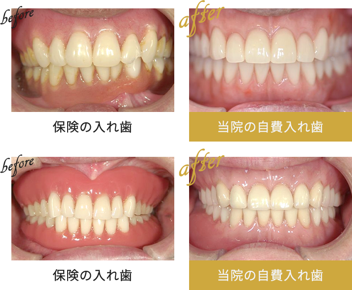 保険の入れ歯と当院の自費入れ歯の比較