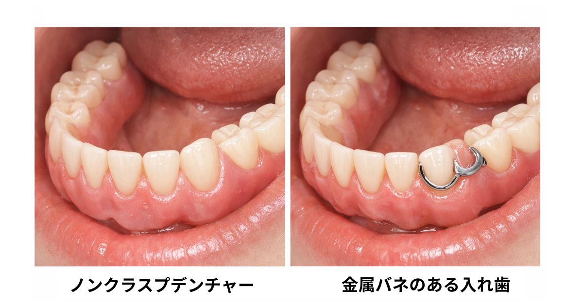 ノンクラスプデンチャーと金属バネのある保険入れ歯の審美性比較