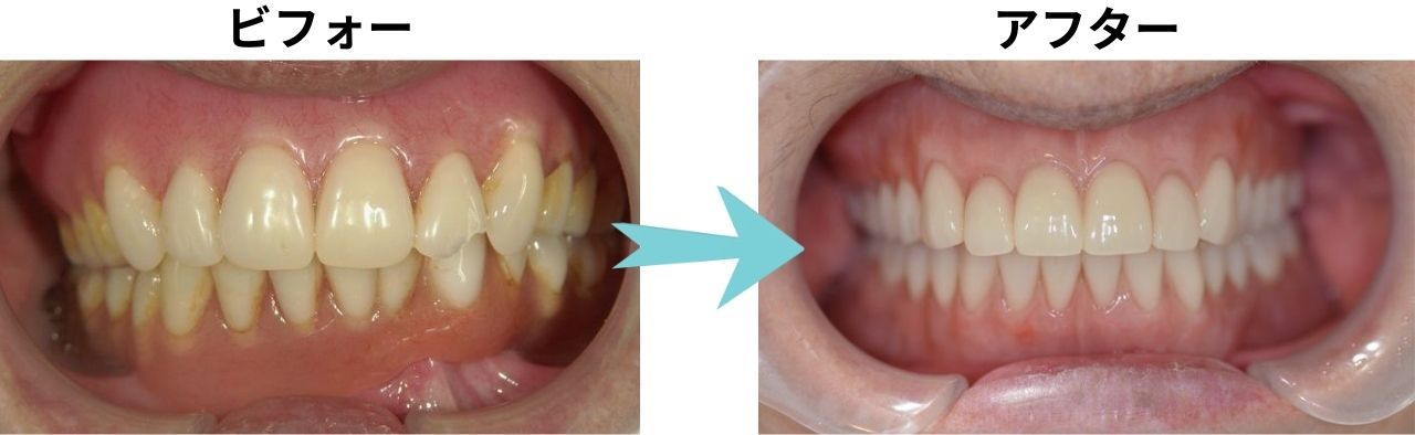 博多プライベート歯科での精密入れ歯治療 Before After 症例写真